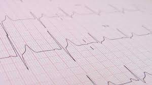 KARDİOSİS TEPA EFOR EKG KAĞIDI